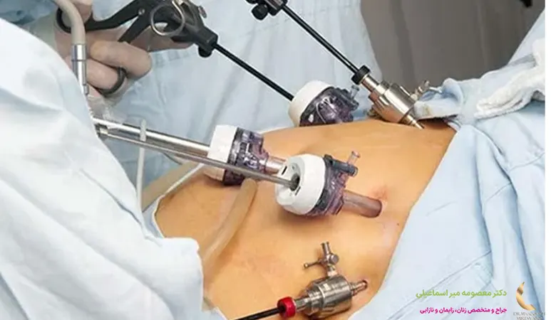 لاپاراسکوپی