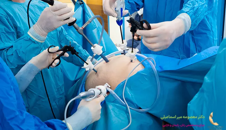 لاپاراسکوپی