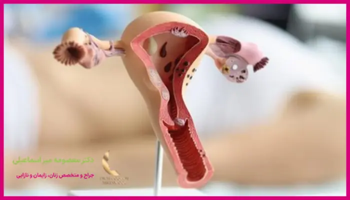 دوره نقاهت لاپاراسکوپی کیست تخمدان