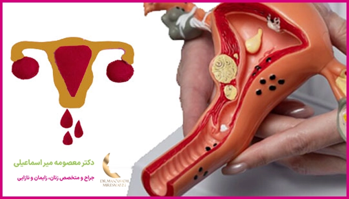 علت خونریزی بعد از لاپاراسکوپی