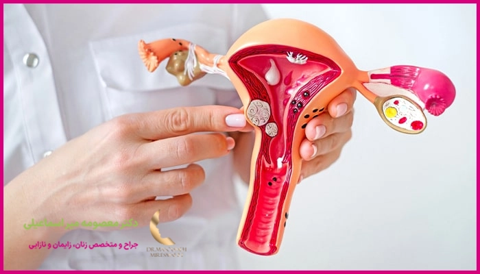 نکاتی که بعد از درمان فیبروم رحم باید رعایت کرد؟